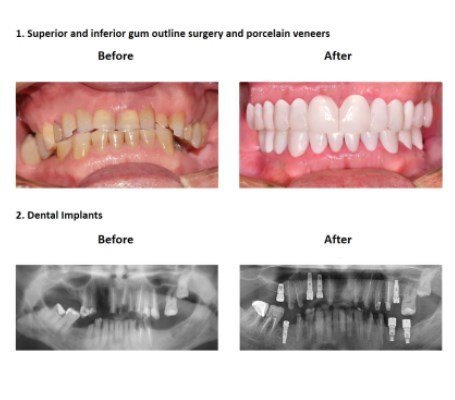 oral rehabilitation Baroda Dental Clinic