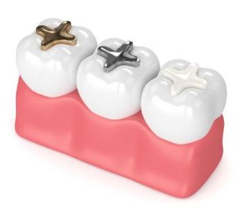 dental filling Baroda Dental Clinic