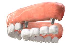 dental implants Baroda Dental Clinic