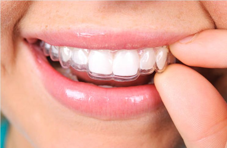 teeth straightening Baroda Dental Clinic