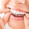 Why Would You Need A Dental Crown And What Are The Benefits Of Dental Crowns