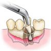 Steps of Tooth Surgical Extraction