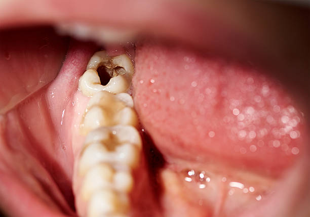 dental filling vadodara