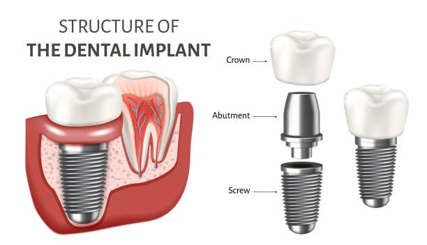 Single Tooth Implant in Vadodara