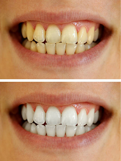 teeth whitening Baroda Dental Clinic