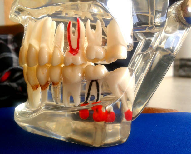 root canal Baroda Dental Clinic