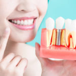 Protecting the Teeth With Dental Crowns – What Types Are Available?